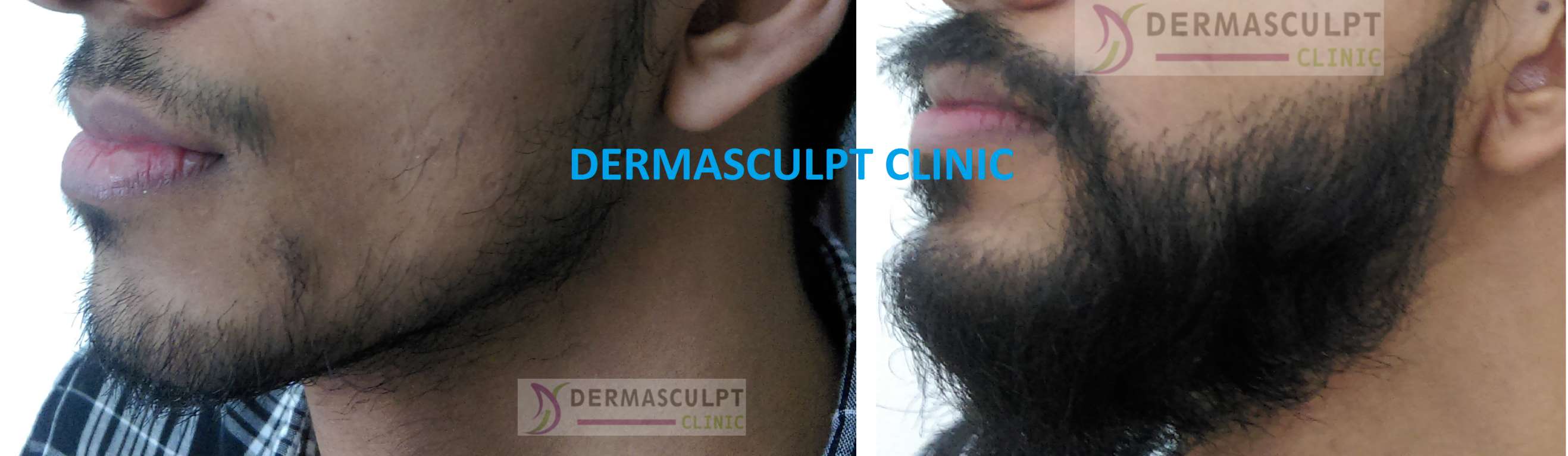 hair-transplant-bangalore